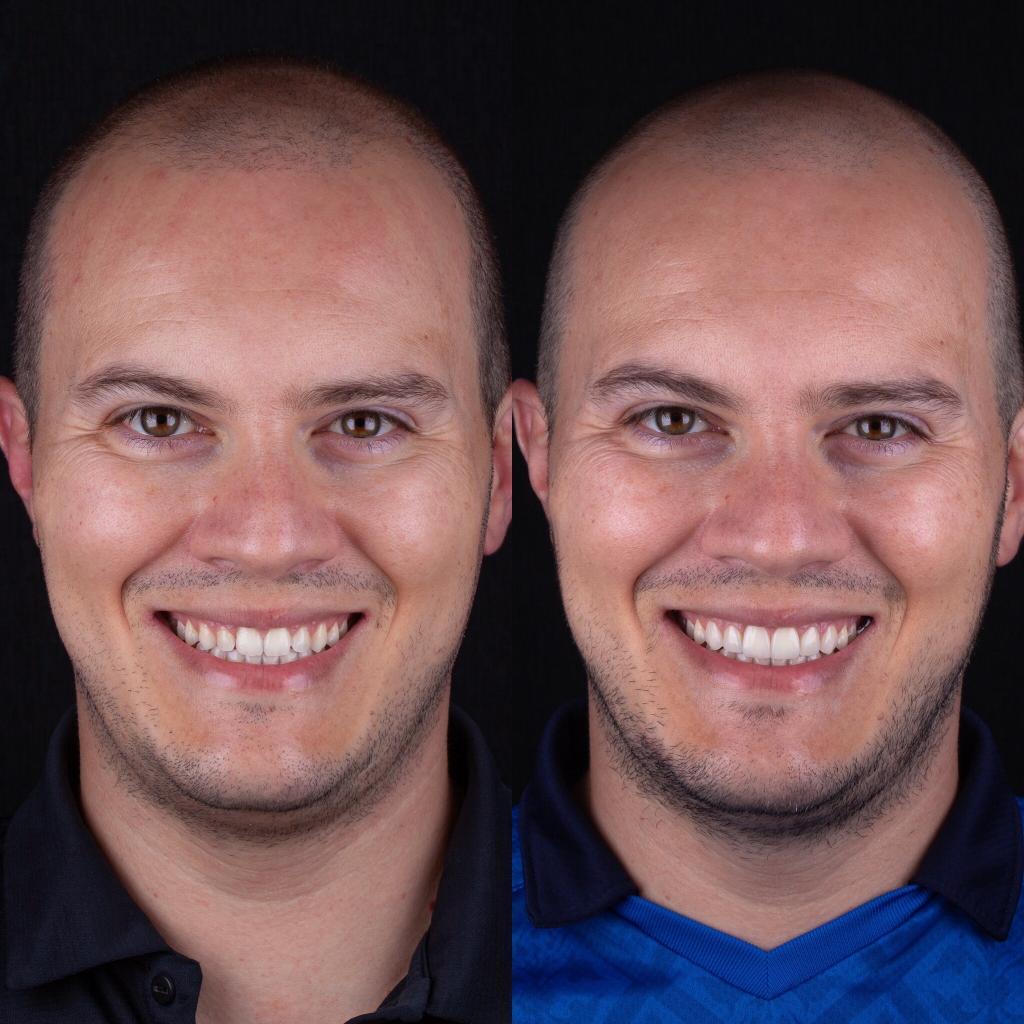 lente dental antes e depois Felipe