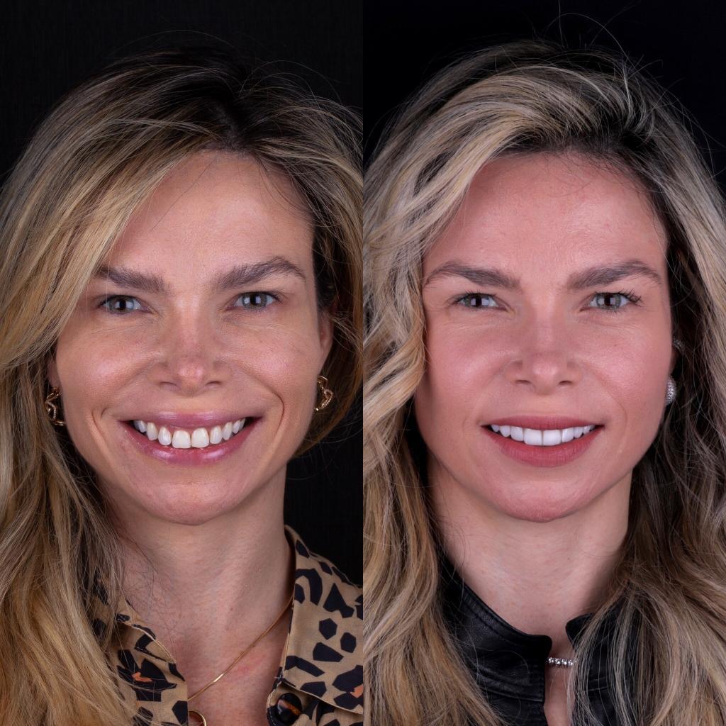 lente dental antes e depois Ana