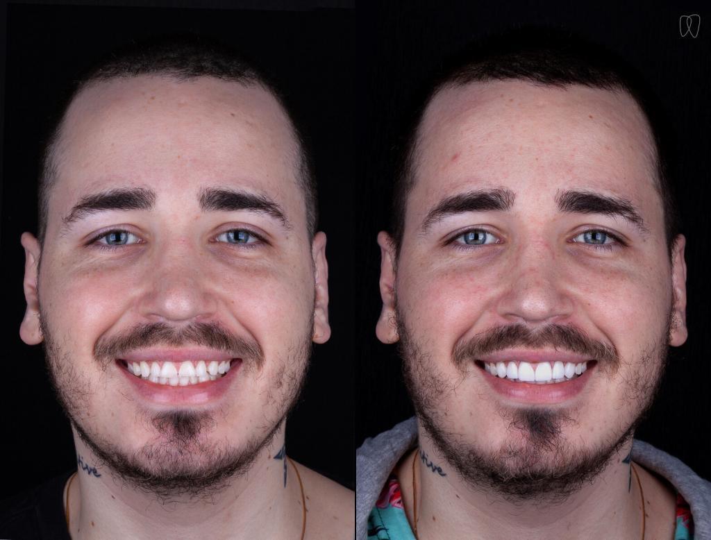 lente de contato dental antes e depois Tyler