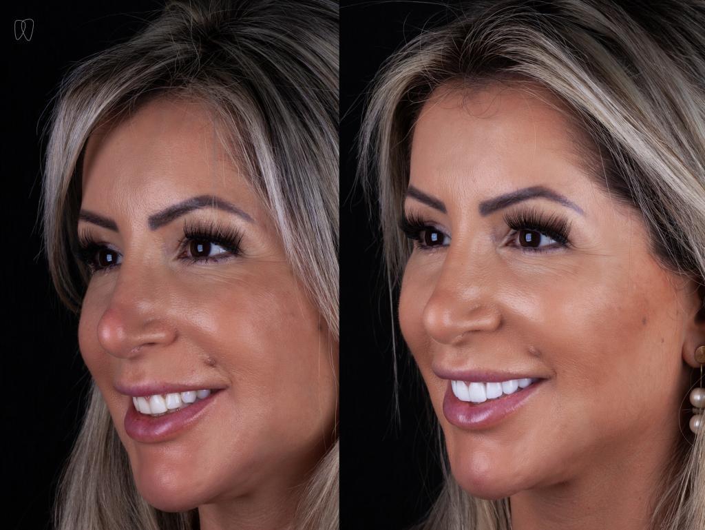 lente de contato antes e depois Andressa