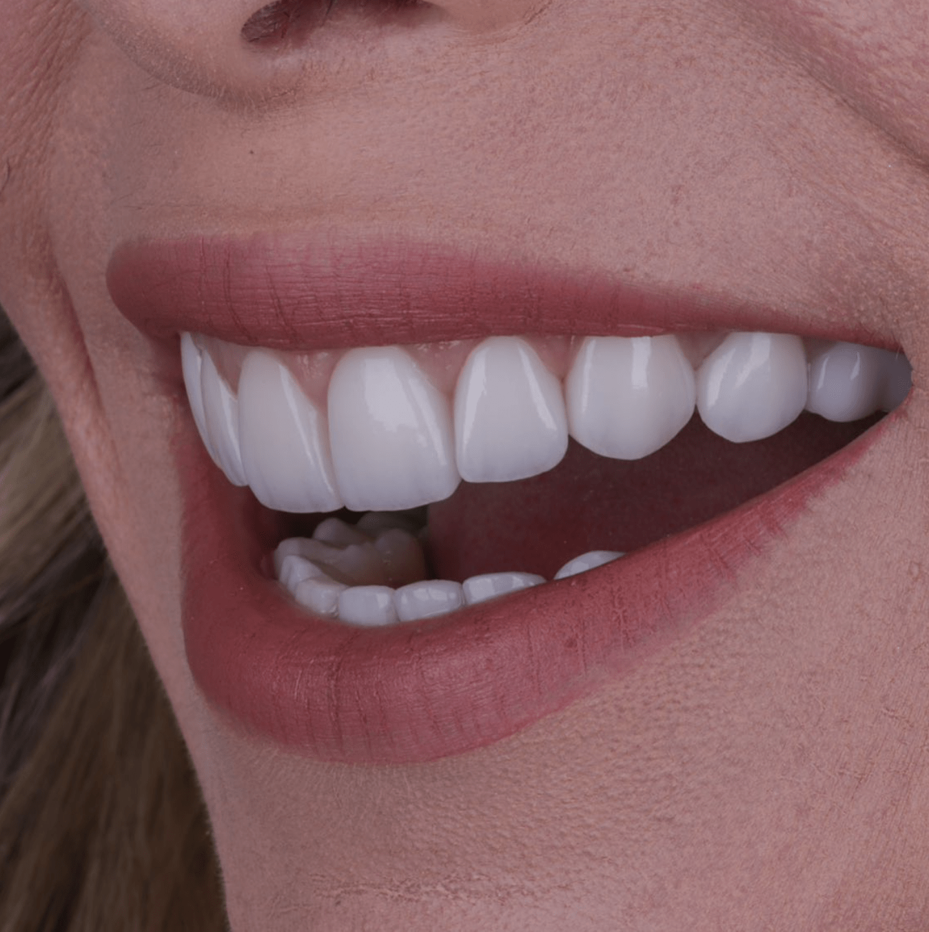 sorriso lente dental
